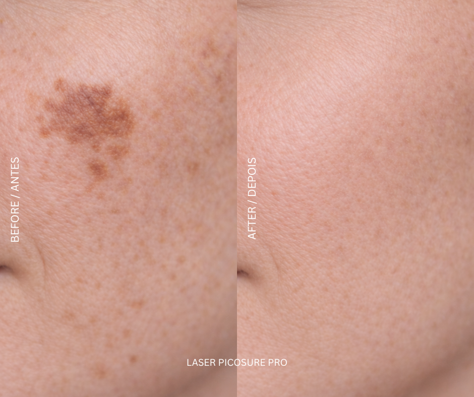 PicoSure Pro laser treatment device at AD Lisbon